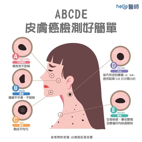 臉突然長痣|皮膚長痣、長斑是皮膚癌前兆？皮膚癌初期4大症狀快。